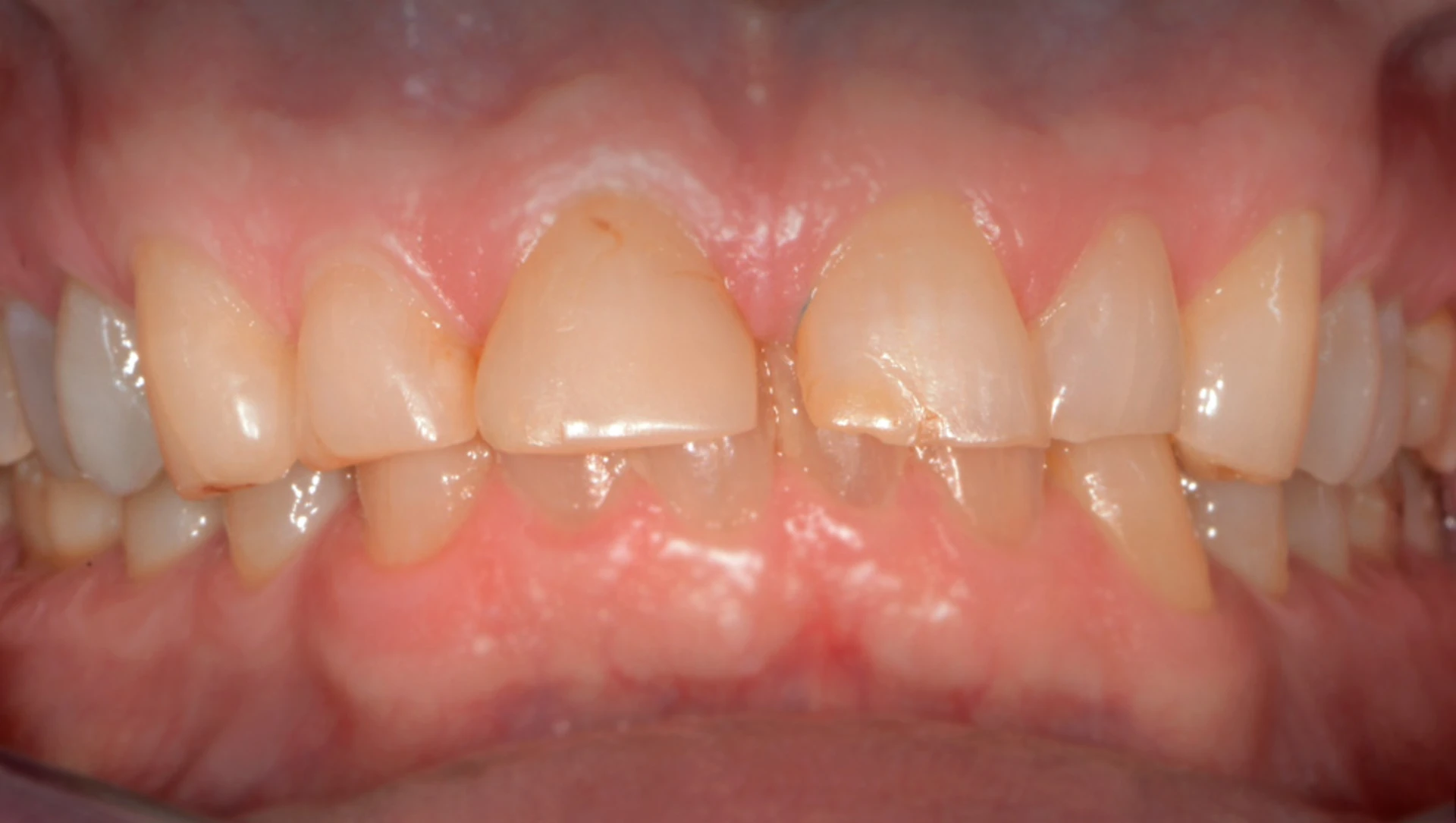 Syreskader og tanngnissing